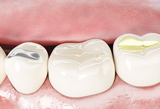 Fillings & Restorative Dentistry